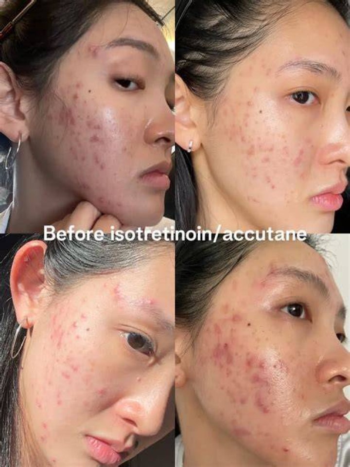 Are Asians more likely to get acne?