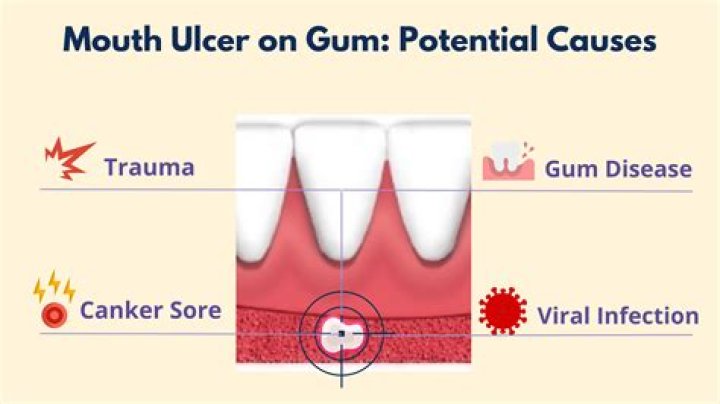 Can ulcer cause shaking?