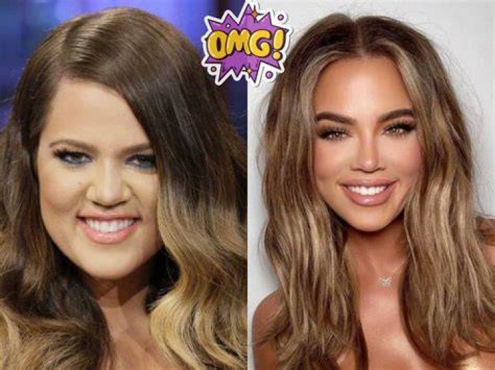 Did Khloe Kardashian get her teeth done?