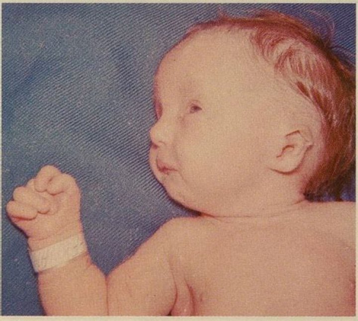 Do trisomy 18 babies kick?