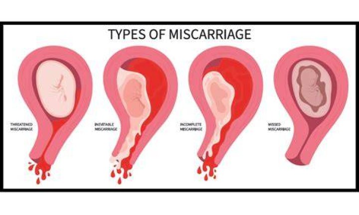 How do I help my daughter through a miscarriage?