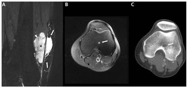 What does a sarcoma look like on MRI?