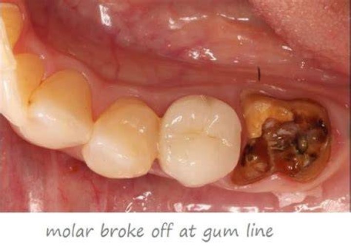 What should I do about a molar broken off at the gum line?