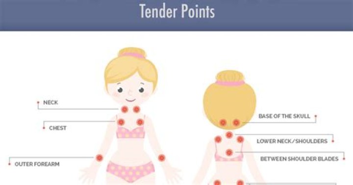 Where are the tender points of fibromyalgia?
