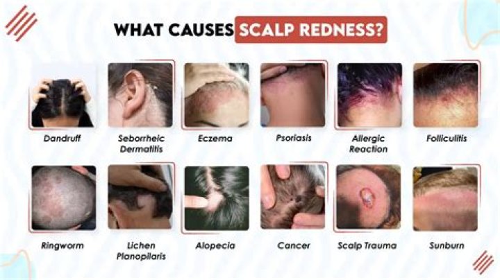 Why does my head bleed when I scratch dandruff?